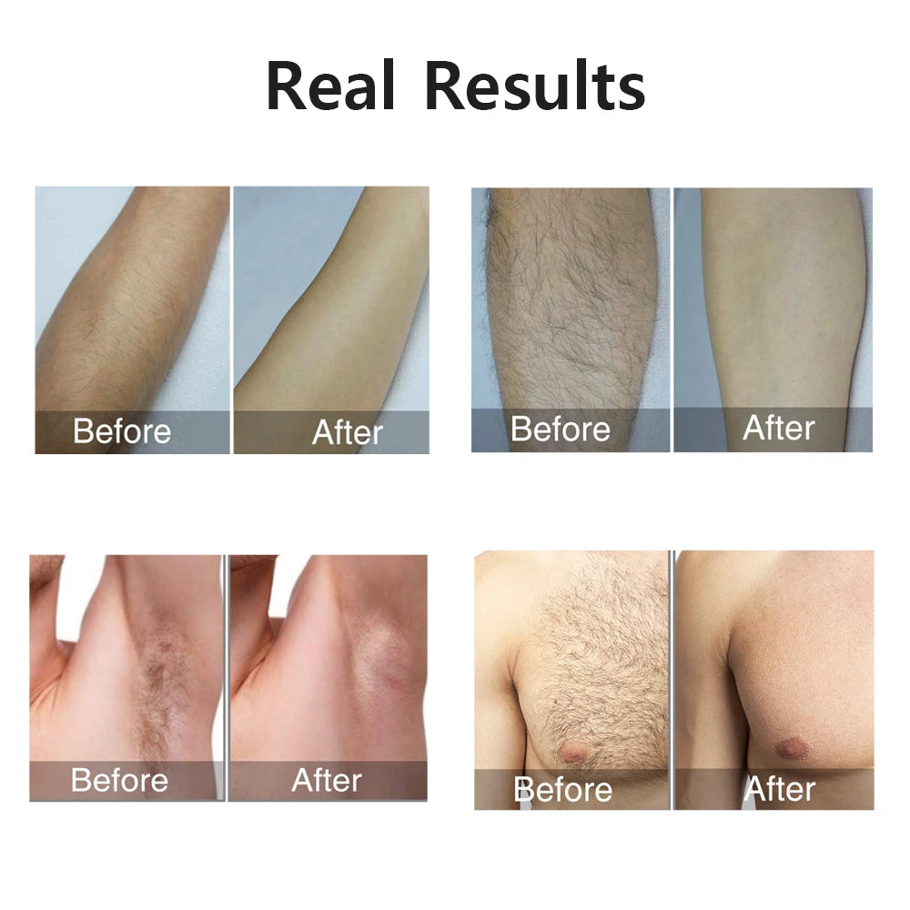 IPL Laser Hair Removal Epilator – 999,999 Flashes